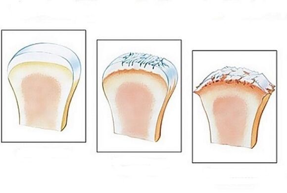 Joint damage at different stages of the development of arthropathy