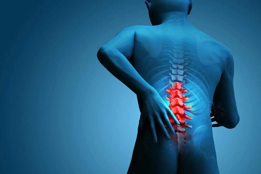 The main symptom of lumbar osteochondrosis is low back pain. 