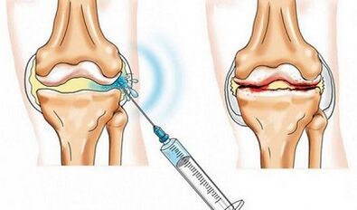 Knee joint blocking