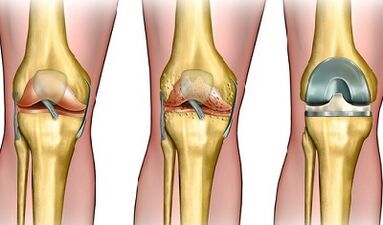 The degree of joint development of knee joints
