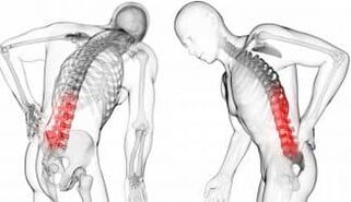 Vertebral hernia - Complications and complications of osteochondrosis
