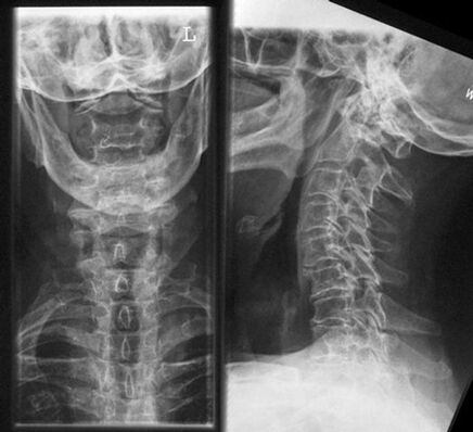 Cervical X-ray - Diagnostic methods for osteochondrosis