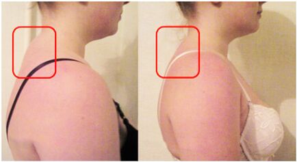 The formation of muscle rollers and cervical bone cartilage degeneration