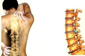 Back pain at different stages of development of cervical osteochondrosis