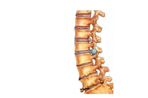 Damage to the spine with cervical bone and cartilage disease