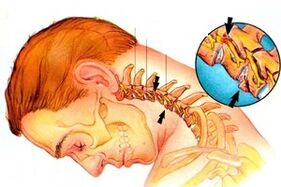 Nerves sandwiched in the spine with cervical bone and cartilage
