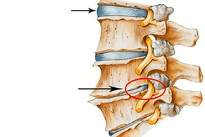 Normal and damaged intervertebral discs with cervical osteochondral disease