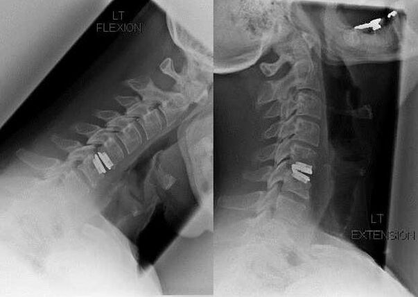 Image of spine after surgery