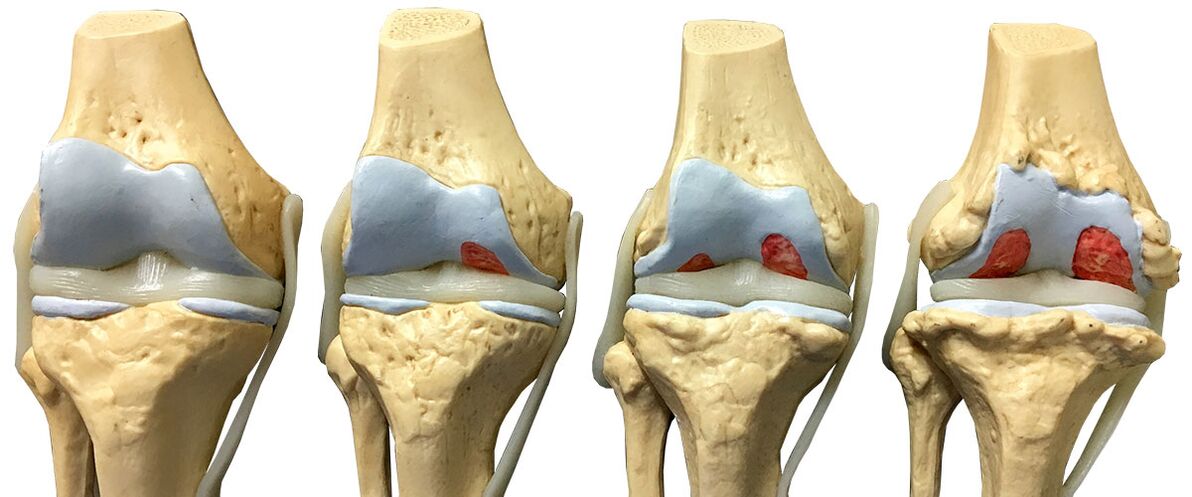 Stages of Arthropathy