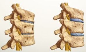 What does osteochondrosis look like