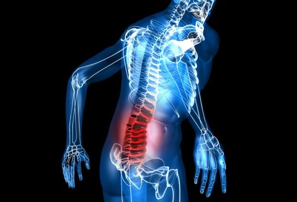 What is lumbar osteochondrosis