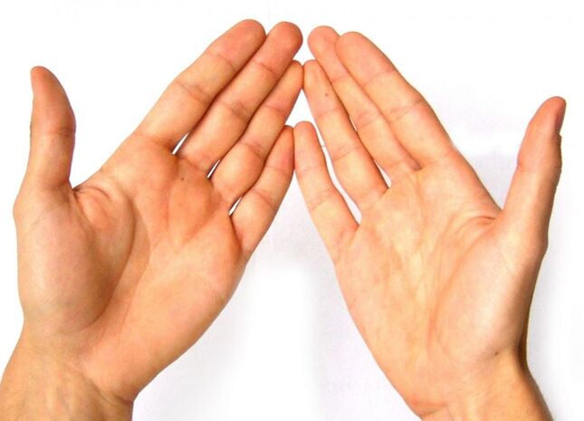Rheumatoid arthritis affects finger joints due to immune system dysfunction
