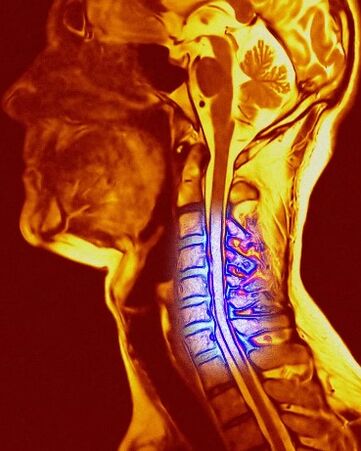 Cervical Spine Chondrosis
