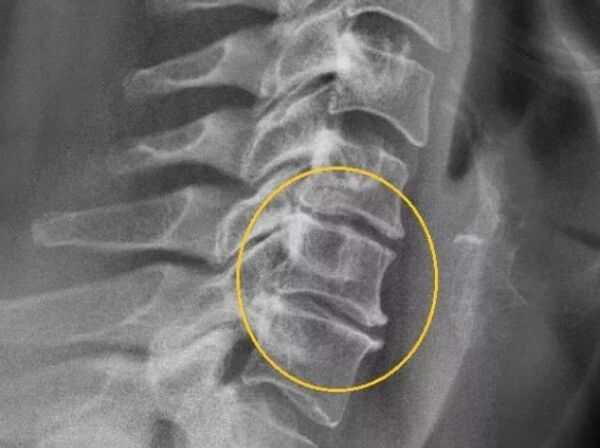 Cervical osteochondrosis on X-ray